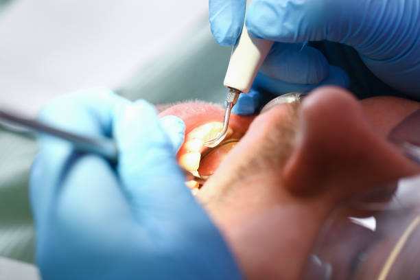 Best Emergency Root Canal Treatment in Wellington, CO