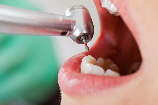 Best Emergency Gum Treatment in Wellington, CO